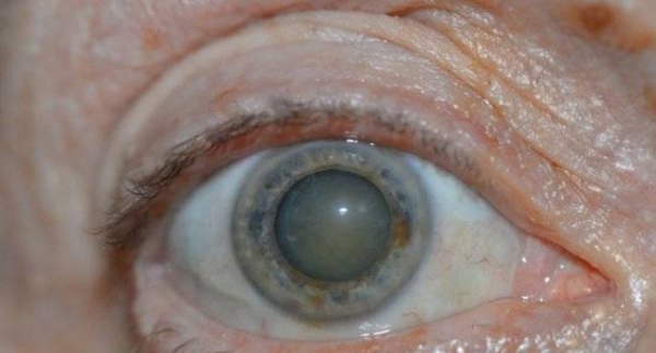 7 признаков катаракты, о которых важно знать